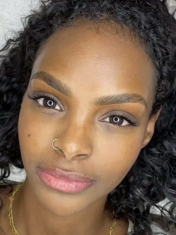 Brow Lift
